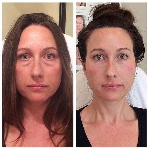 Girl before and after the renewal of facial rays