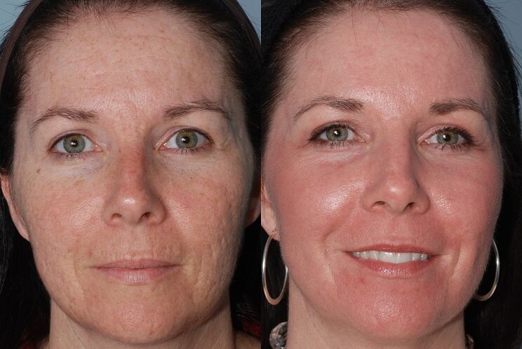 before and after skin renewal