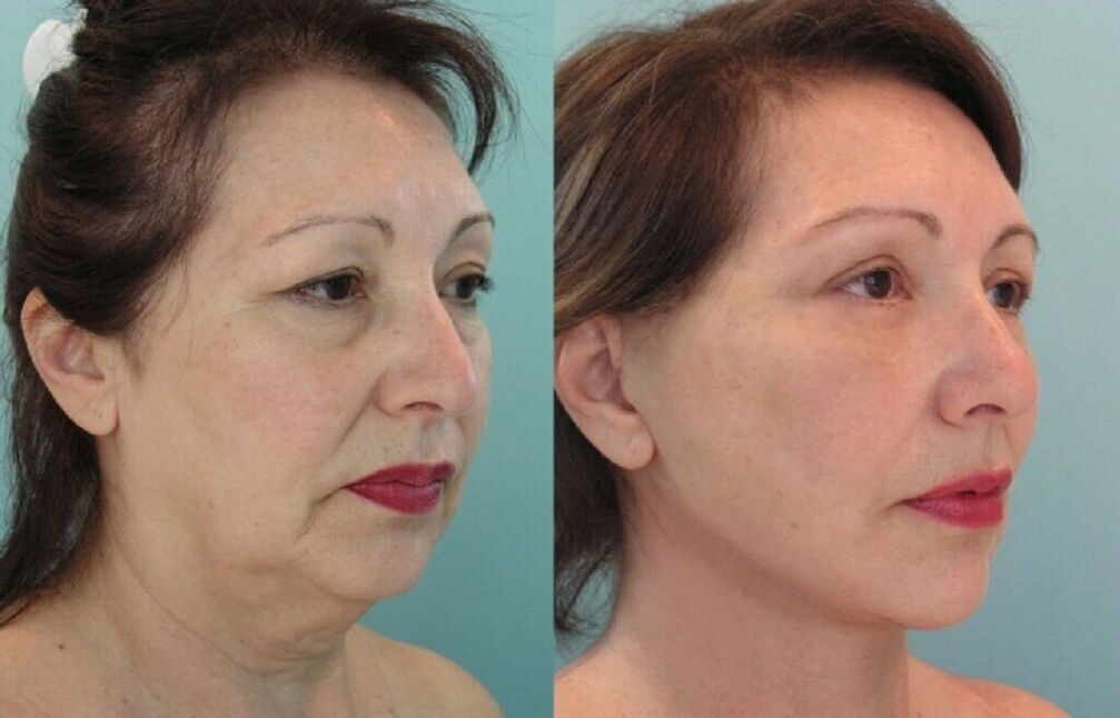image before and after skin rejuvenation